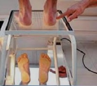 Zborcená klenba dítěte na podoskopu